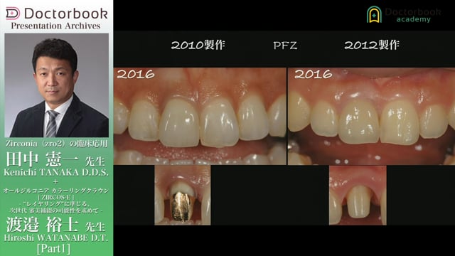 Zirconia（zro2）の臨床応用  / オールジルコニア カラーリングクラウン[ ZIRCOS-E ]- “レイヤリング“に準じる、次世代 審美補綴の可能性を求めて -