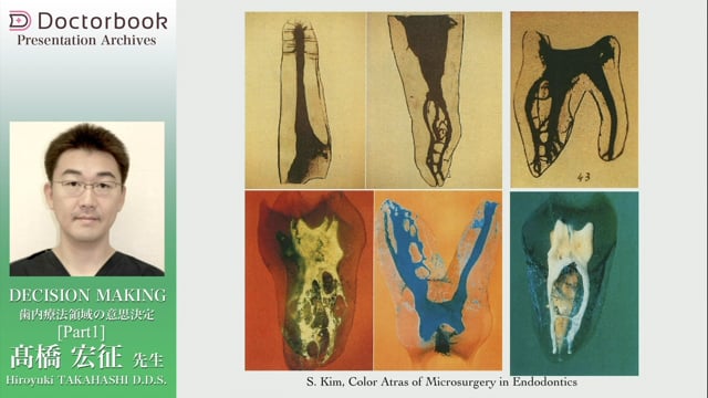 DECISION MAKING 歯内療法領域の意思決定