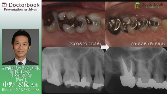 支台歯形成の基本的原則と臨床における工夫や注意事項 | Doctorbook 