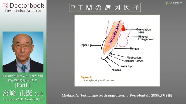 病的歯牙移動（PTM）への考え方と実際 〜保存的治療を目指して〜