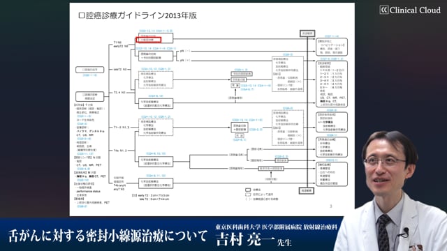 舌がんに対する密封小線源治療について