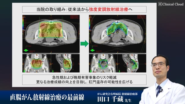 直腸がん放射線治療の最前線