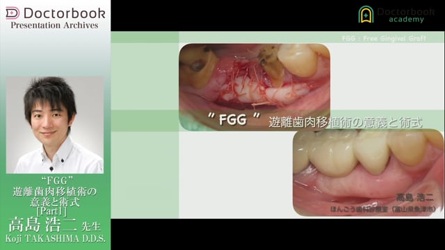 ”FGG” 遊離歯肉移植術の意義と術式