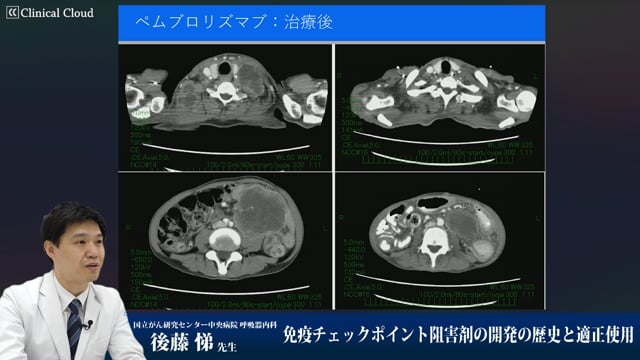 免疫チェックポイント阻害剤の開発の歴史と適正使用