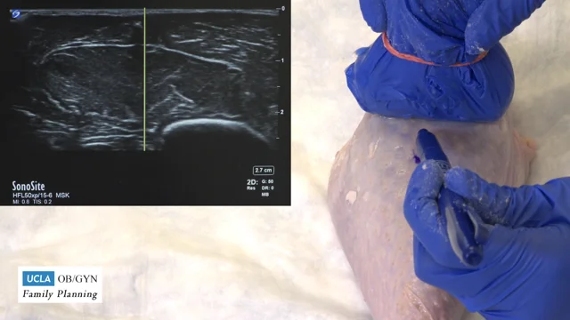 Upstream Implant Removal Video (Pop-Out Method) - Innovating Education in  Reproductive Health