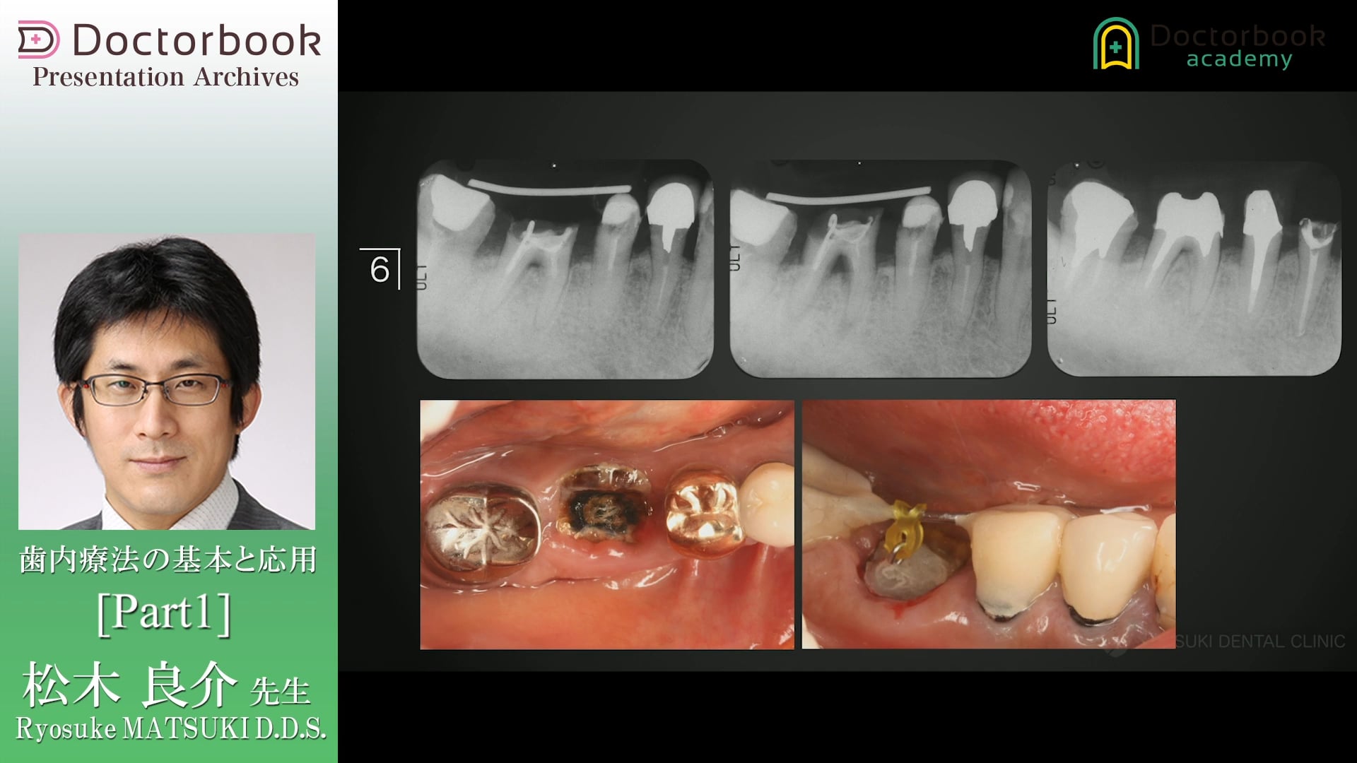 #1 歯内療法の臨床力
