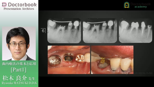 #1 歯内療法の臨床力
