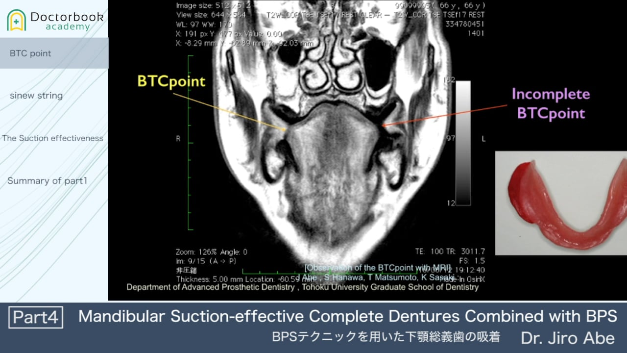 Mandibular Suction-effective Complete Dentures Combined with BPS #4