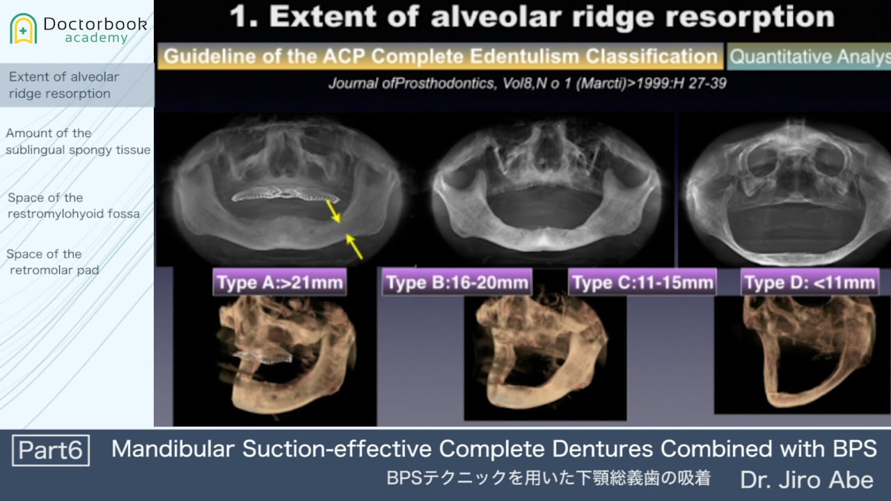 Mandibular Suction-effective Complete Dentures Combined with