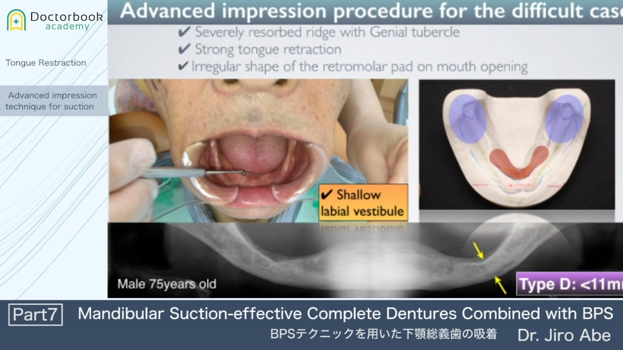Mandibular Suction-effective Complete Dentures Combined with BPS #7