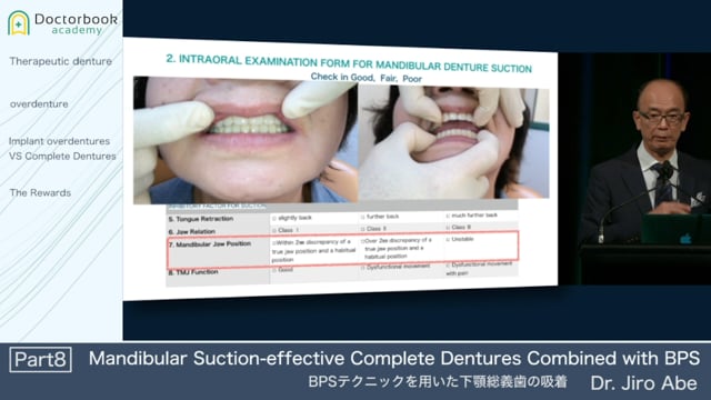 Mandibular Suction-effective Complete Dentures Combined with BPS #8