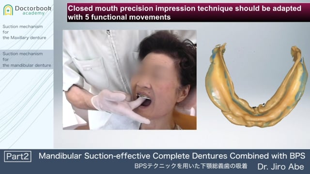 Mandibular Suction-effective Complete Dentures Combined with BPS #2