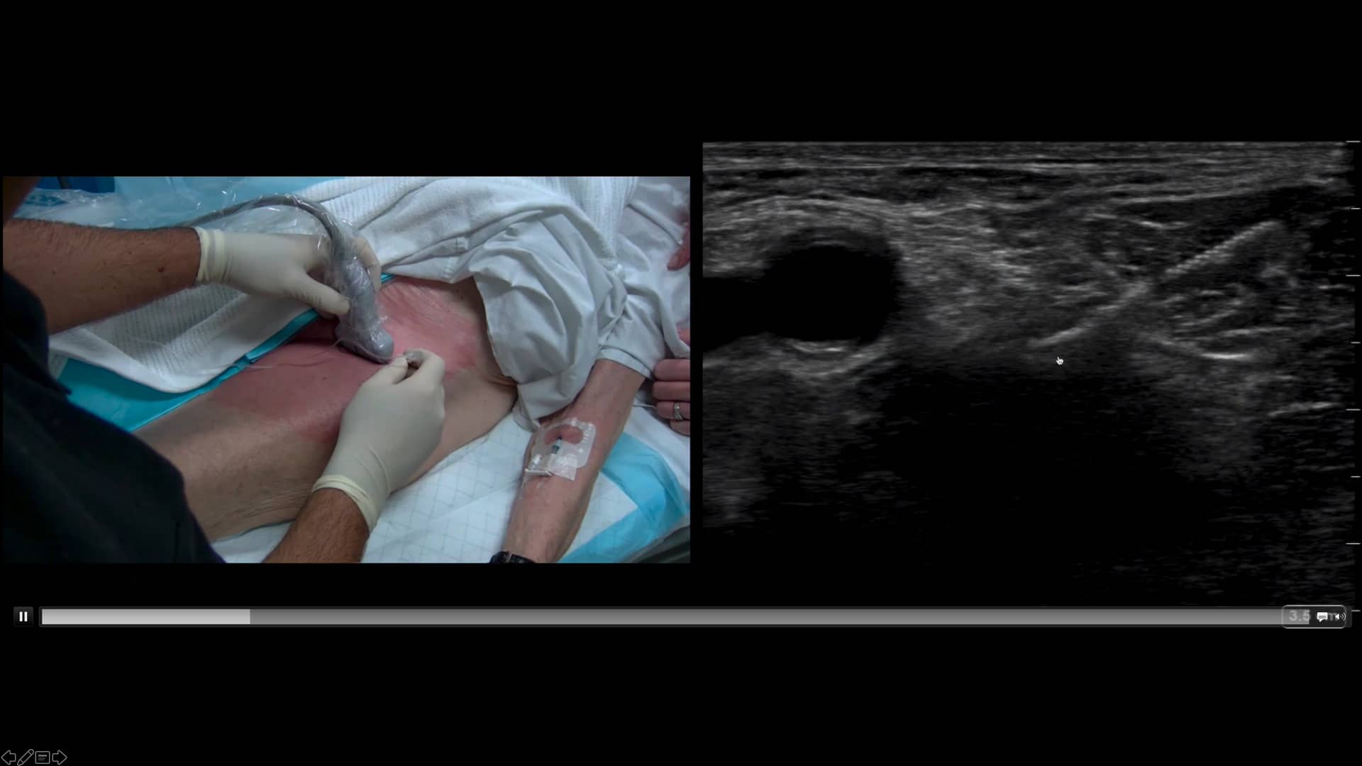 Femoral Nerve Block On Vimeo