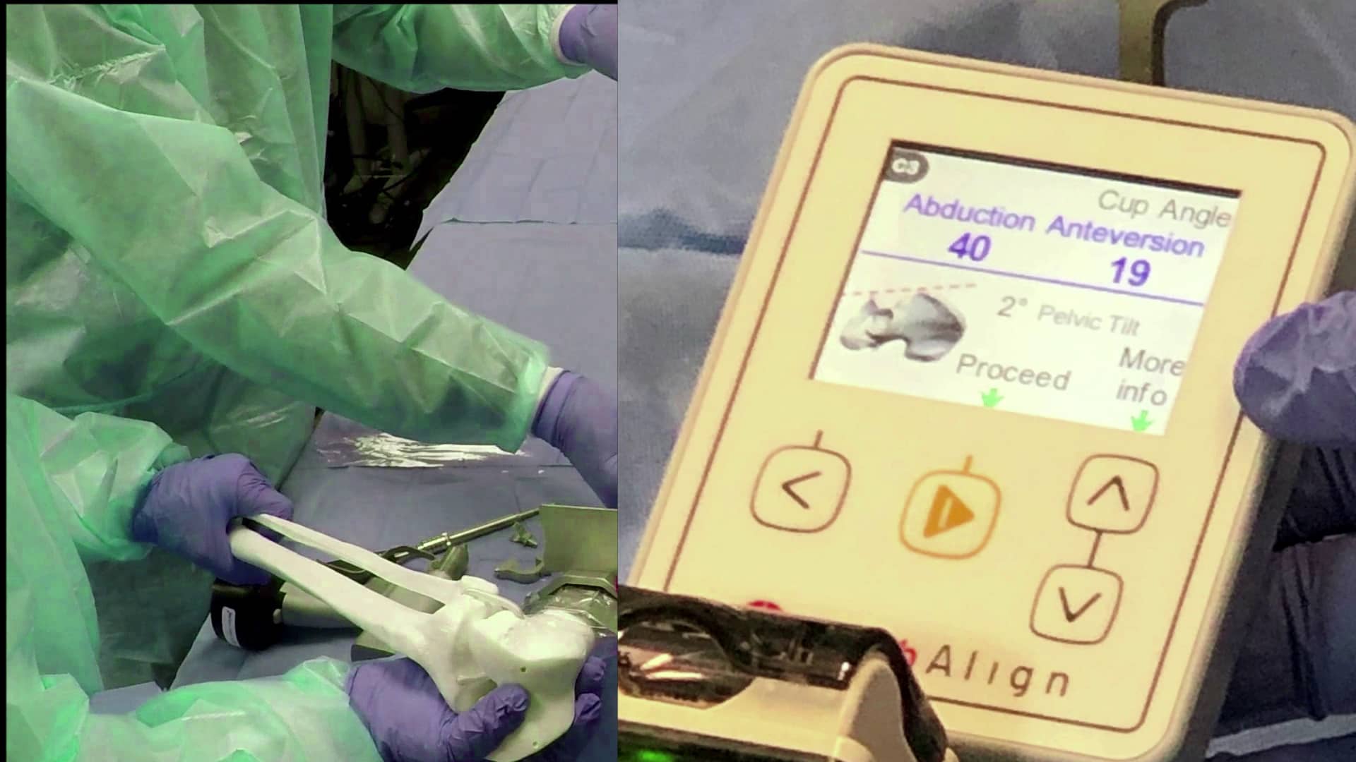 HipAlign (lateral approach) Sawbones Demonstration Video Surgical
