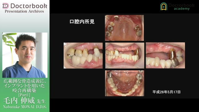 広範囲な骨造成後に、インプラントを用いた咬合再構築