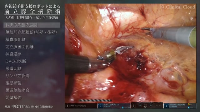 内視鏡手術支援ロボットによる前立腺全摘除術 ～CASE；右神経温存・左リンパ節郭清 Part1