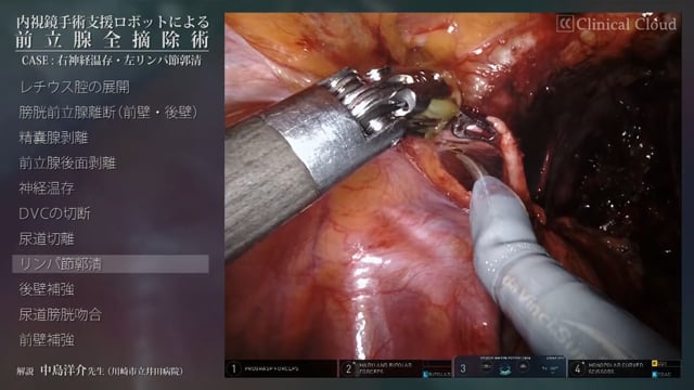 内視鏡手術支援ロボットによる前立腺全摘除術 ～CASE；右神経温存・左リンパ節郭清 Part3