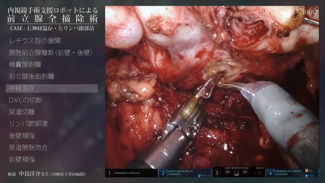 内視鏡手術支援ロボットによる前立腺全摘除術 ～CASE；右神経温存・左リンパ節郭清 Part2