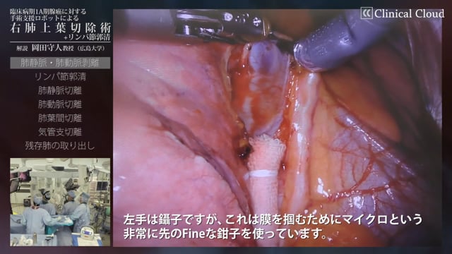 臨床病期1A期腺癌に対する手術支援ロボットによる右肺上葉切除術 +リンパ節郭清（日本語Ver.）