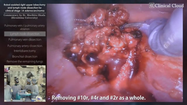 Robot assisted right upper lobectomy and lymph node dissection for clinical stage IA adenocarcinoma