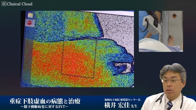 重症下肢虚血の病態と治療、膝下動脈病変に対するEVT