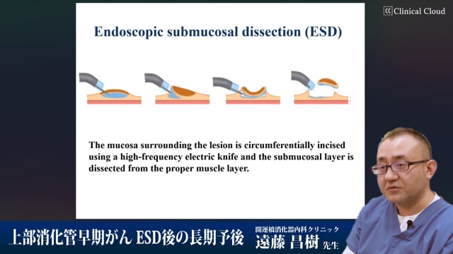 上部消化管早期がん ESD後の長期予後 Part1