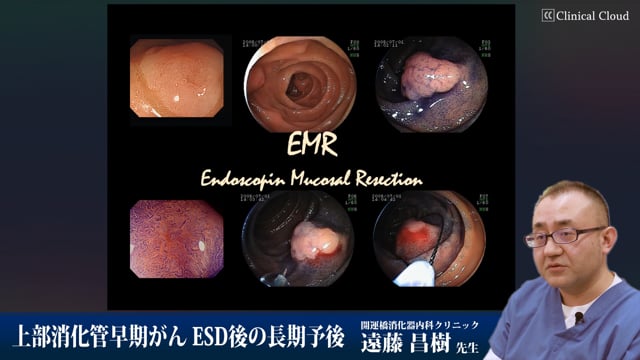 上部消化管早期がん ESD後の長期予後 Part5