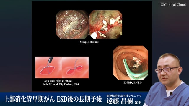 上部消化管早期がん ESD後の長期予後 Part6