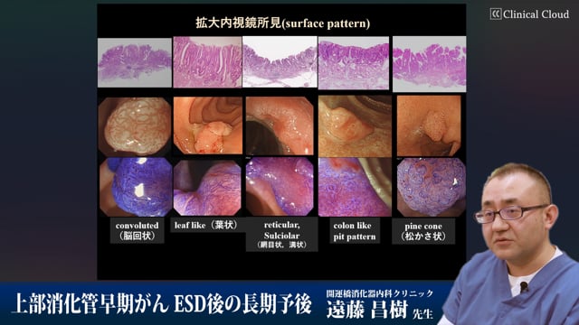 上部消化管早期がん ESD後の長期予後 Part7