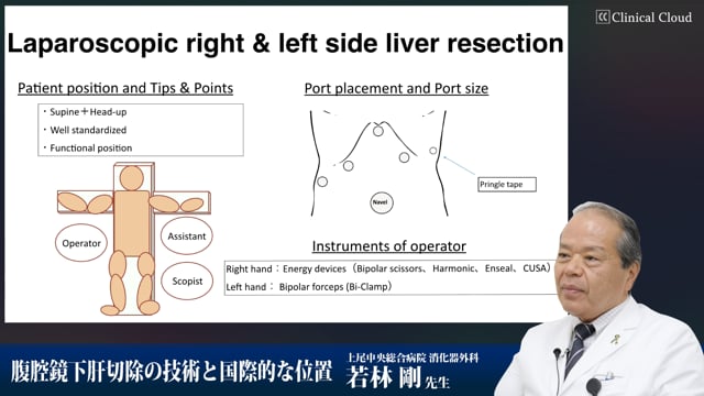 腹腔鏡下肝切除の技術と国際的な位置 Part3