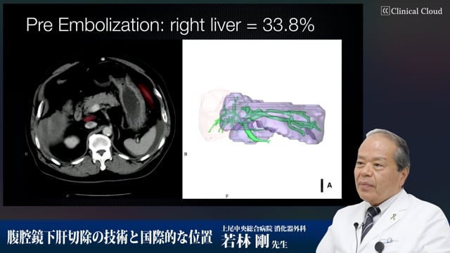 腹腔鏡下肝切除の技術と国際的な位置 Part4