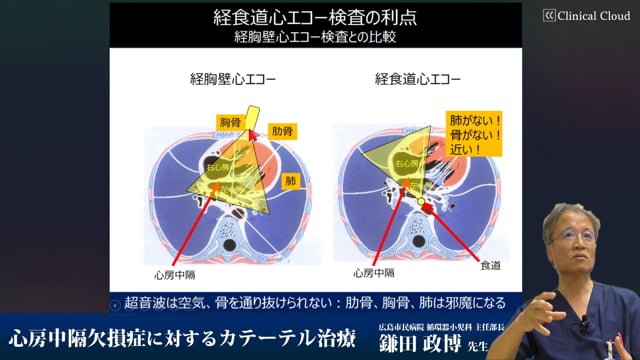 心房中隔欠損症に対するカテーテル治療