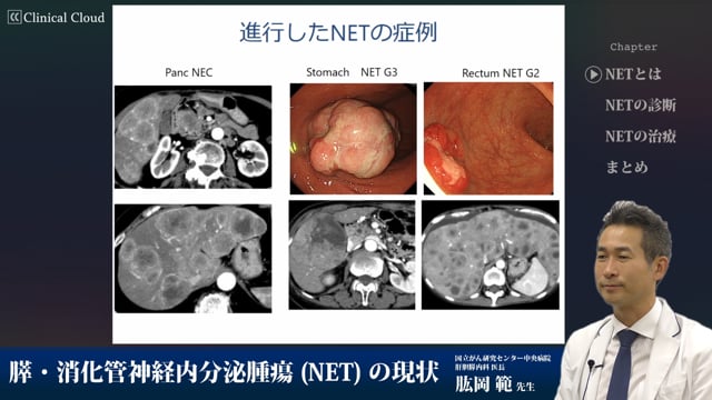 膵・消化管神経内分泌腫瘍(NET)の現状 Part1