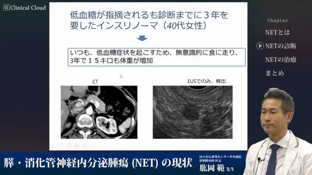 膵・消化管神経内分泌腫瘍(NET)の現状 Part2