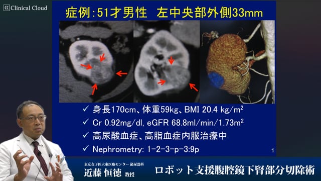 ロボット支援腹腔鏡下腎部分切除術 Part1