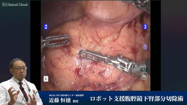 ロボット支援腹腔鏡下腎部分切除術 Part2