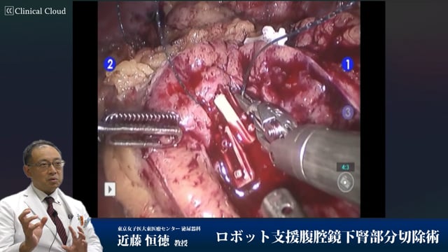 ロボット支援腹腔鏡下腎部分切除術 Part3