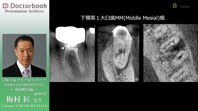 CBCT＆マイクロスコープ 日常臨床で最大限活用する為に 〜歯内療法編〜