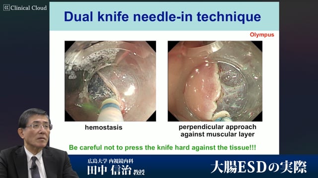 大腸ESDの実際 Part1
