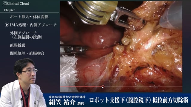 ロボット支援下低位前方切除術 Part2