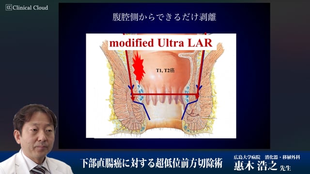 下部直腸癌に対する超低位前方切除術 Part1