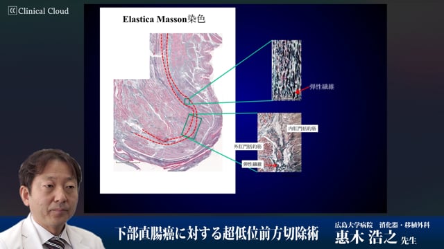 下部直腸癌に対する超低位前方切除術 Part3