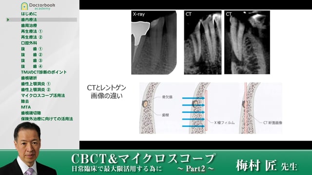 歯内療法でのCTの有用性 #2