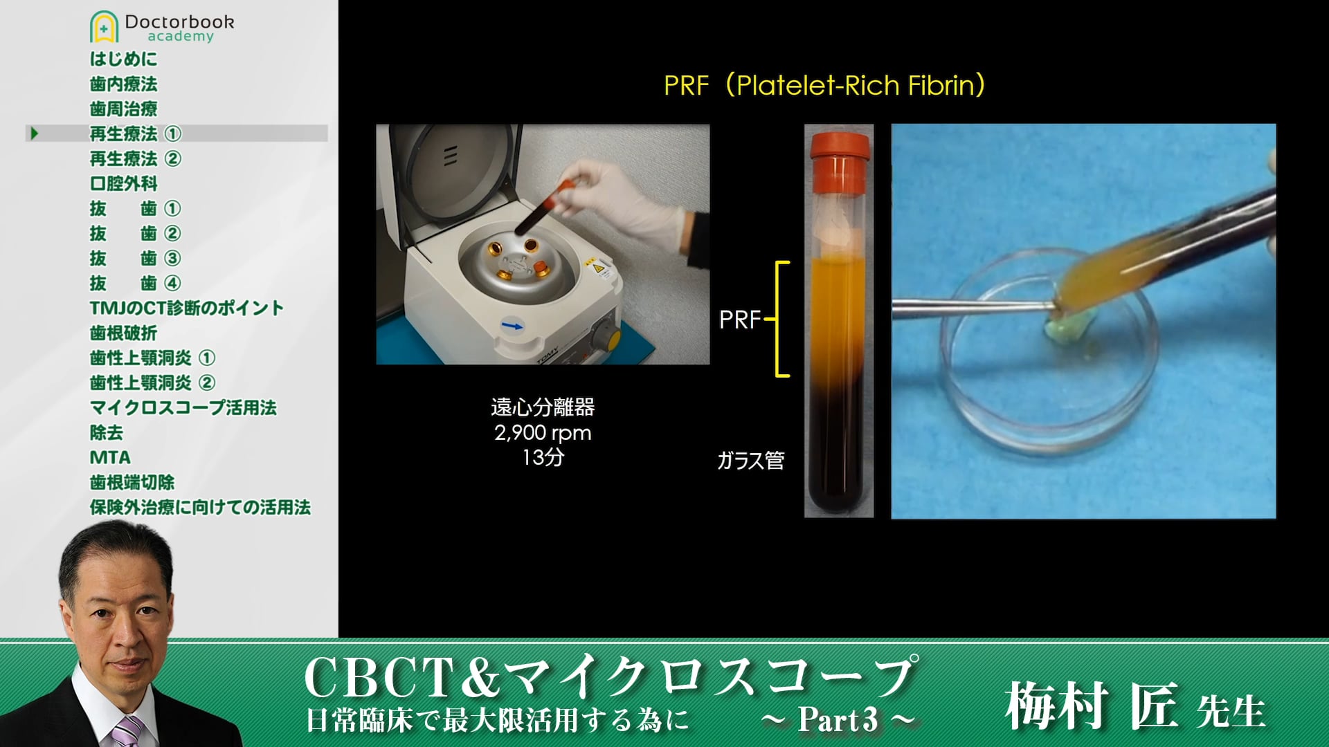 歯周病でのCTの有用性 #3