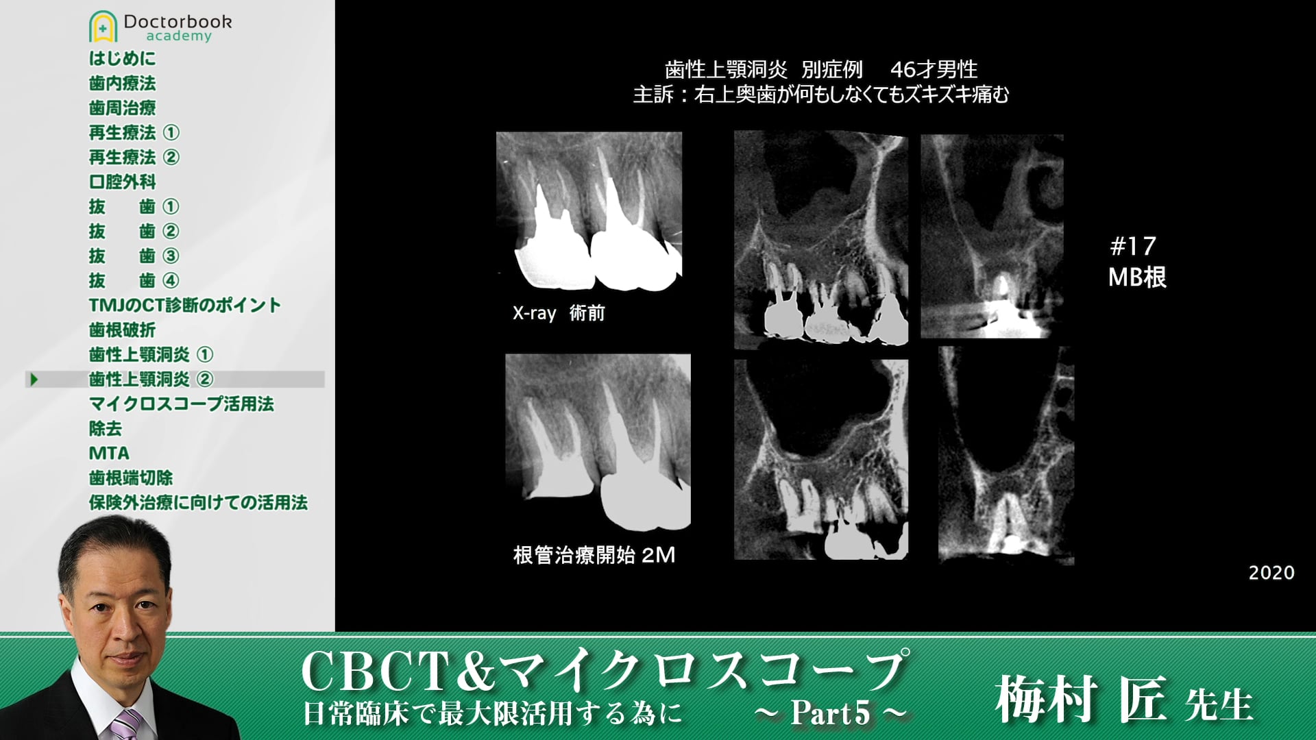 上顎洞病変でのCTの有用性 #5 | Doctorbook academy (ドクター