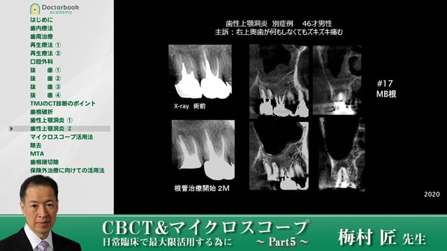 上顎洞病変でのCTの有用性 #5