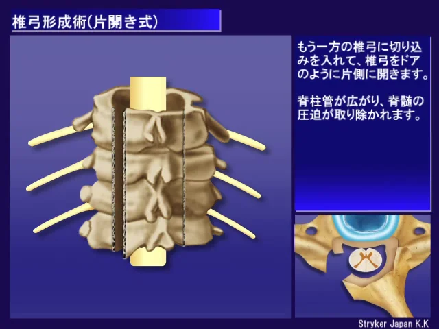 01_頚椎の手術_椎弓形成術（縦割法）