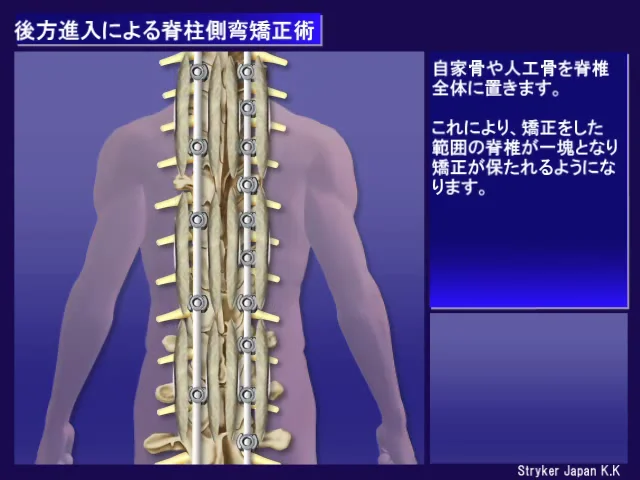 05_胸椎の手術_脊柱側弯症手術