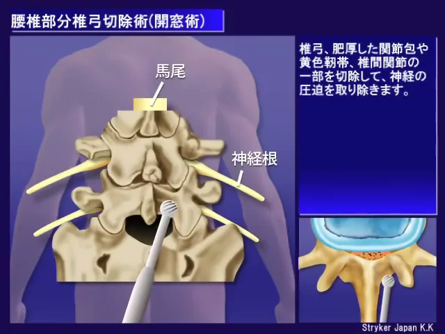 09_腰椎の手術_部分椎弓切除術（開窓術）