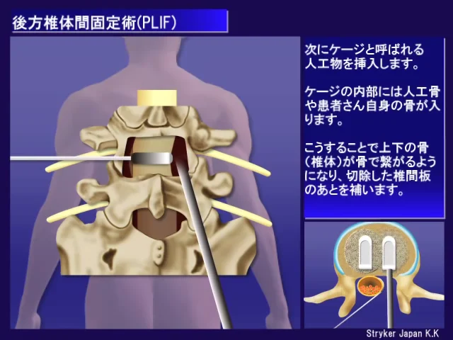 12_腰椎の手術_後方椎体間固定術（PLIF）